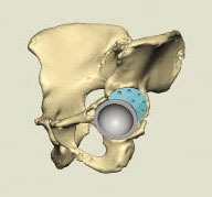 Placement of the cup and augment to fully protect the hip.